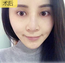 面部提升术
