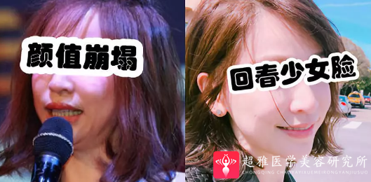 面部提升术