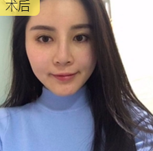 面部提升术