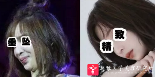 面部提升术