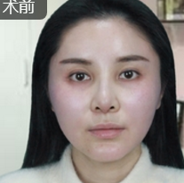 面部提升术