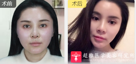 面部提升术