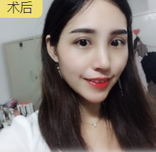 下巴延长术