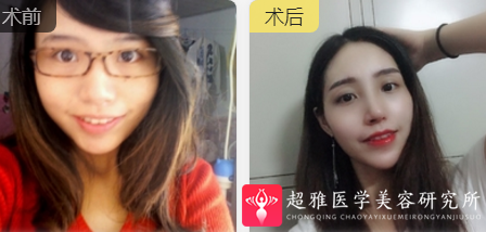 下巴延长术