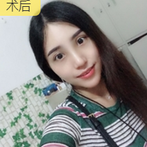 下巴延长术