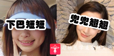 下巴延长术