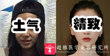 下巴延长术