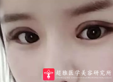 自体脂肪丰面
