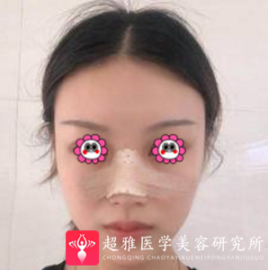 鼻综合整形术