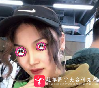 鼻综合整形术