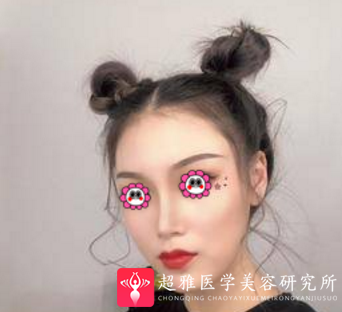 鼻综合整形术