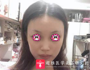 鼻综合整形术