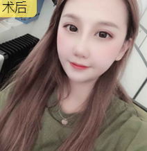 隆鼻手术