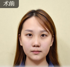 隆鼻手术