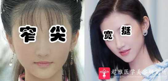 隆鼻手术