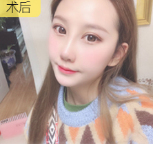 隆鼻手术