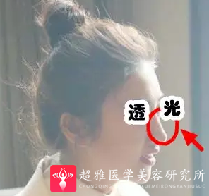 隆鼻手术