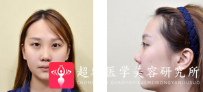 隆鼻手术
