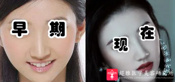 隆鼻手术