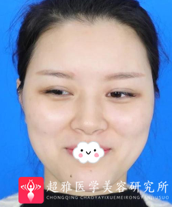 隆鼻手术
