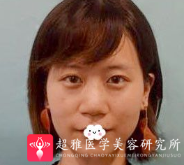 隆鼻手术