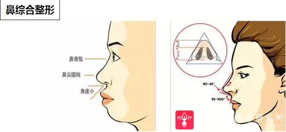 隆鼻手术