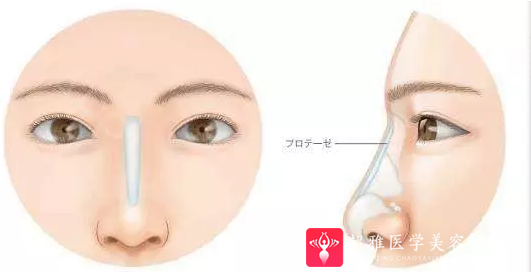 隆鼻手术