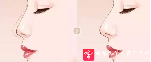 隆鼻手术