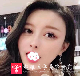 隆鼻手术