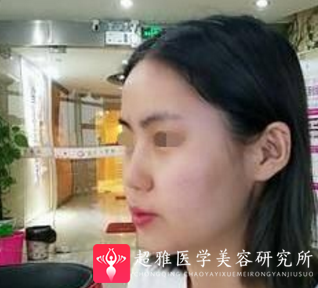 下巴延长术
