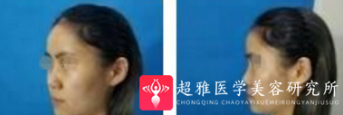 下巴延长术