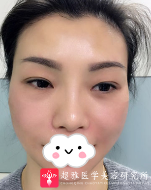 不开刀下巴延长术