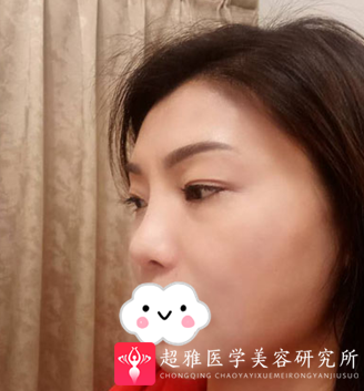 不开刀下巴延长术
