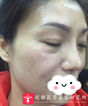 不开刀下巴延长术