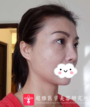 不开刀下巴延长术
