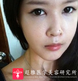 不开刀下巴延长术