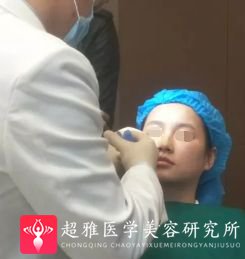 不开刀下巴延长术
