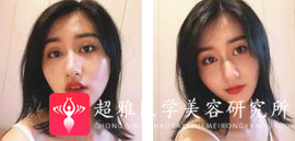 面部提升术