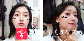 面部提升术