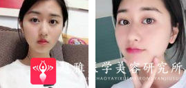 面部提升术