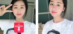 面部提升术
