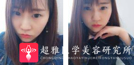 面部提升术