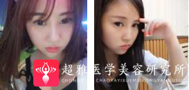 面部提升术
