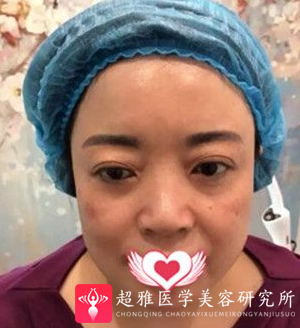 面部提升术