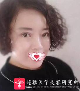 面部提升术