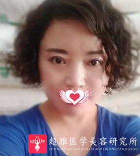 面部提升术