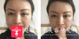 面部提升术