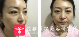 面部提升术
