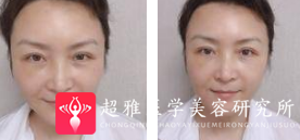面部提升术