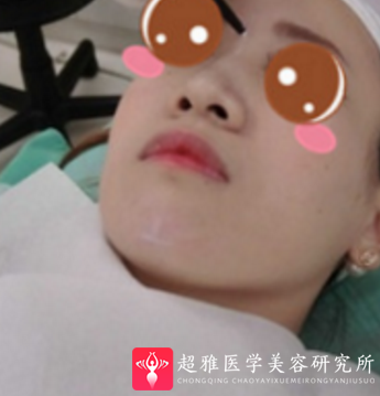 下巴延长术